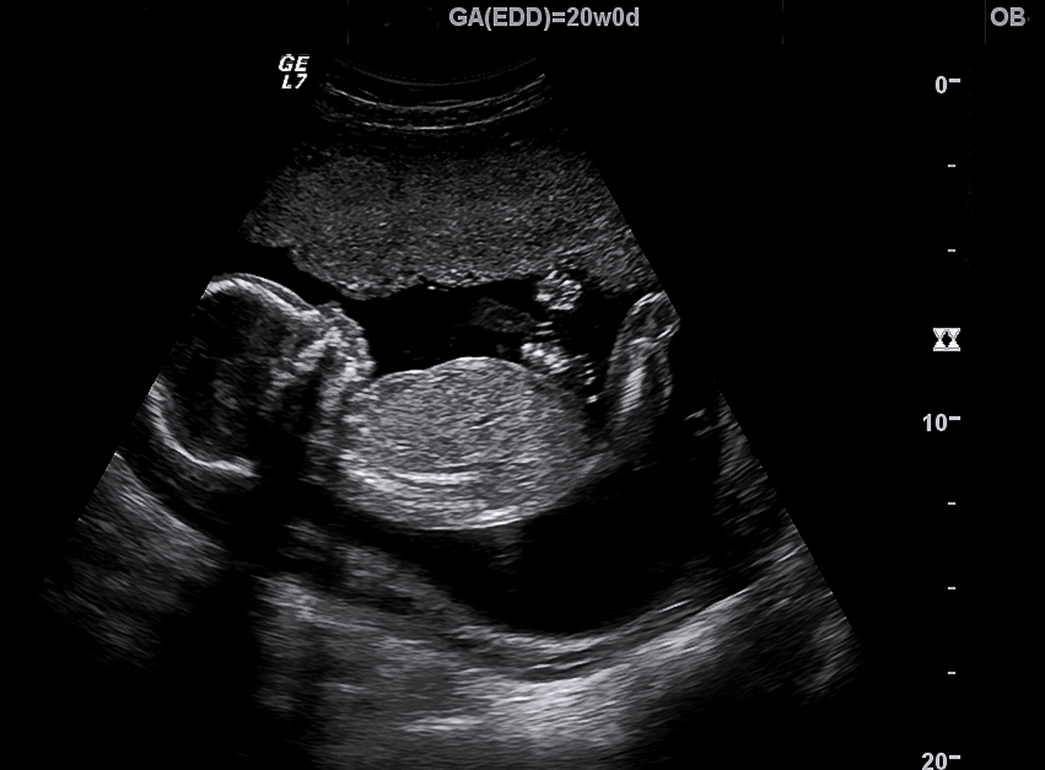 Abortion Employee Quits After Seeing Ultrasound