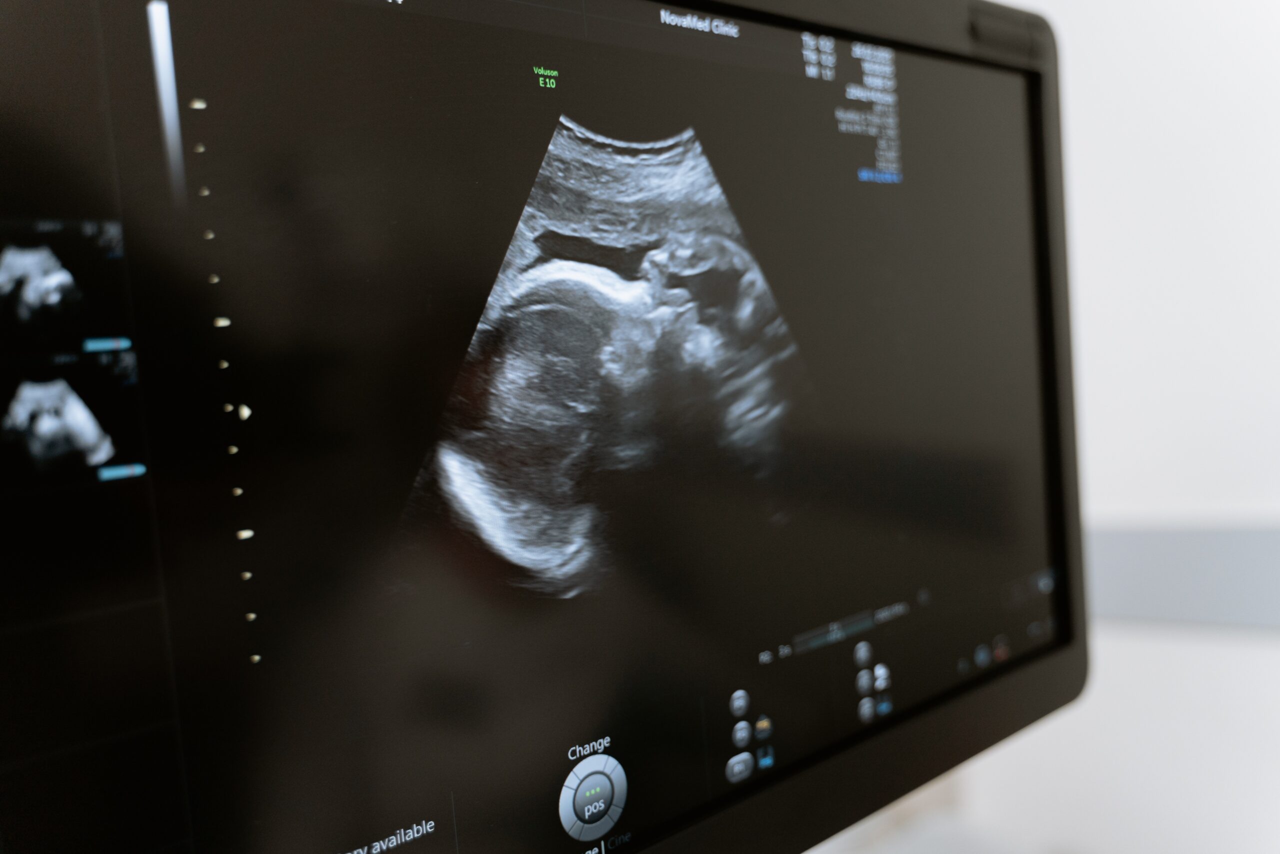 Another Ultrasound Success Story